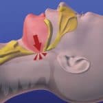 Total airway obstruction