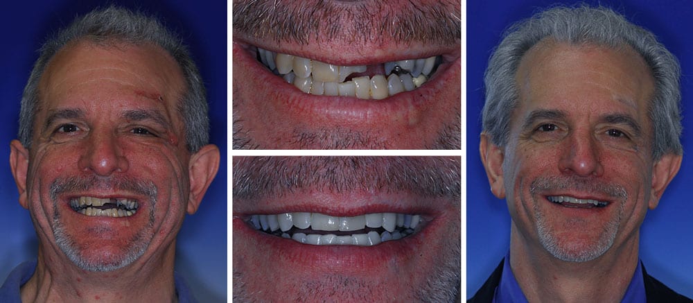 Andy - before and after smile - Beth Snyder, DMD
