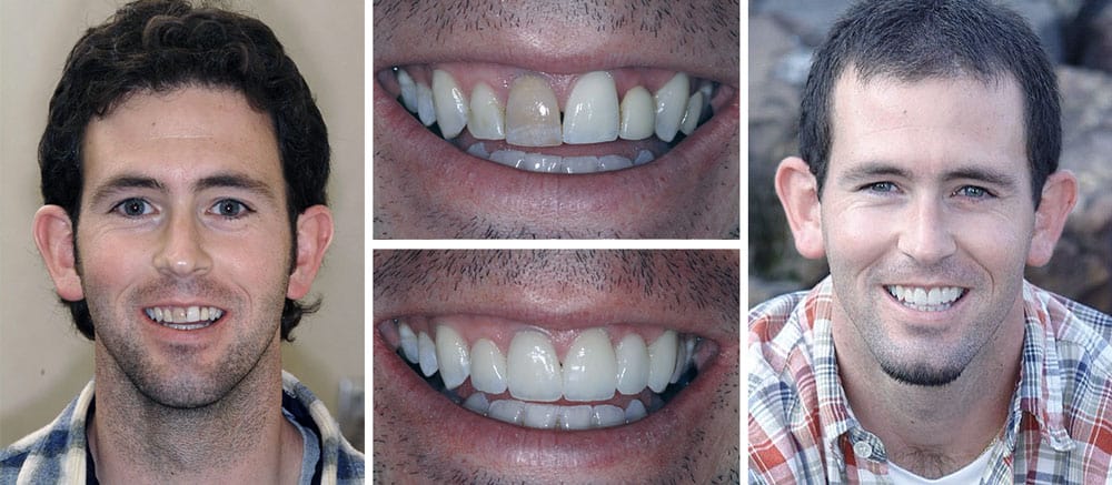 Sean - before and after smile - Beth Snyder, DMD